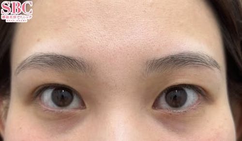 【20代女性・目元】週末二重(R)・ヒアルロン酸涙袋_before