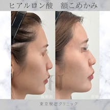 【女性・凹み】ヒアルロン酸(額・こめかみ)_before_aftar