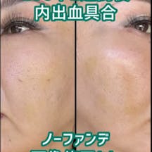 【女性・顔1】ショッピングスレッド_before_aftar