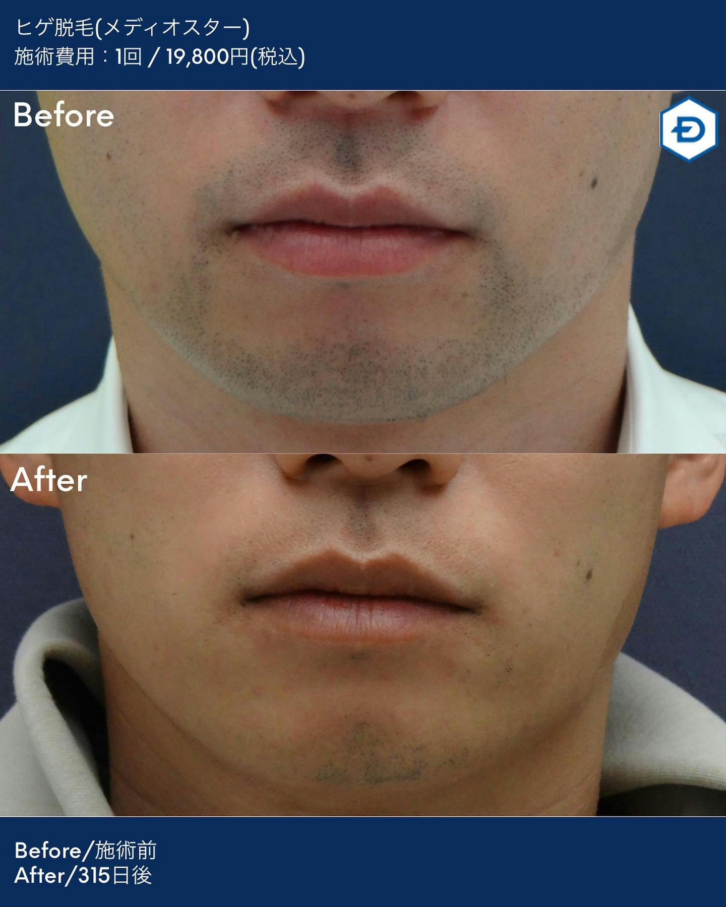 【男性・ヒゲ】ヒゲ脱毛(メディオスター)_before_aftar