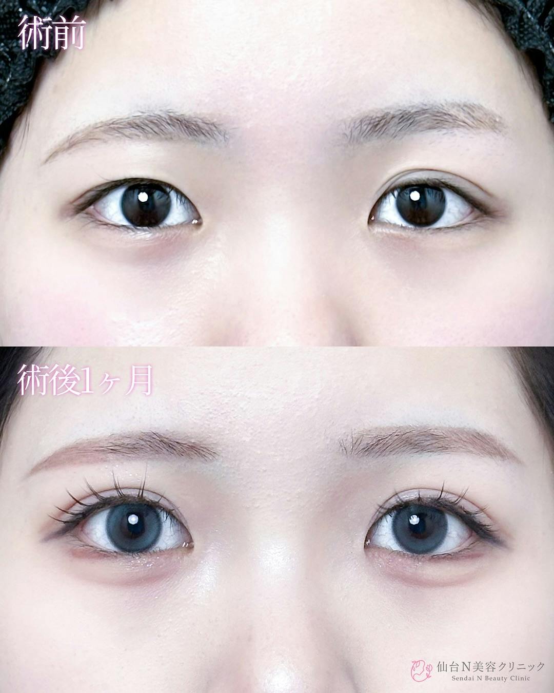 【女性・目元】二重埋没法（シークレットトリプル）_before_aftar