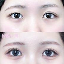 【女性・目元】二重埋没法(シークレットトリプル)_before_aftar
