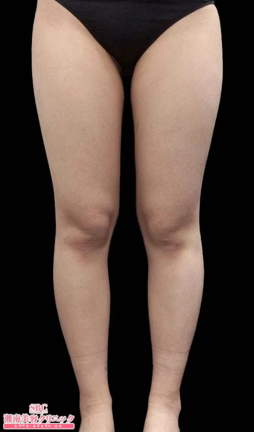 【女性・下半身】根こそぎVASER脂肪吸引(大腿全周＋膝＋臀部)_before