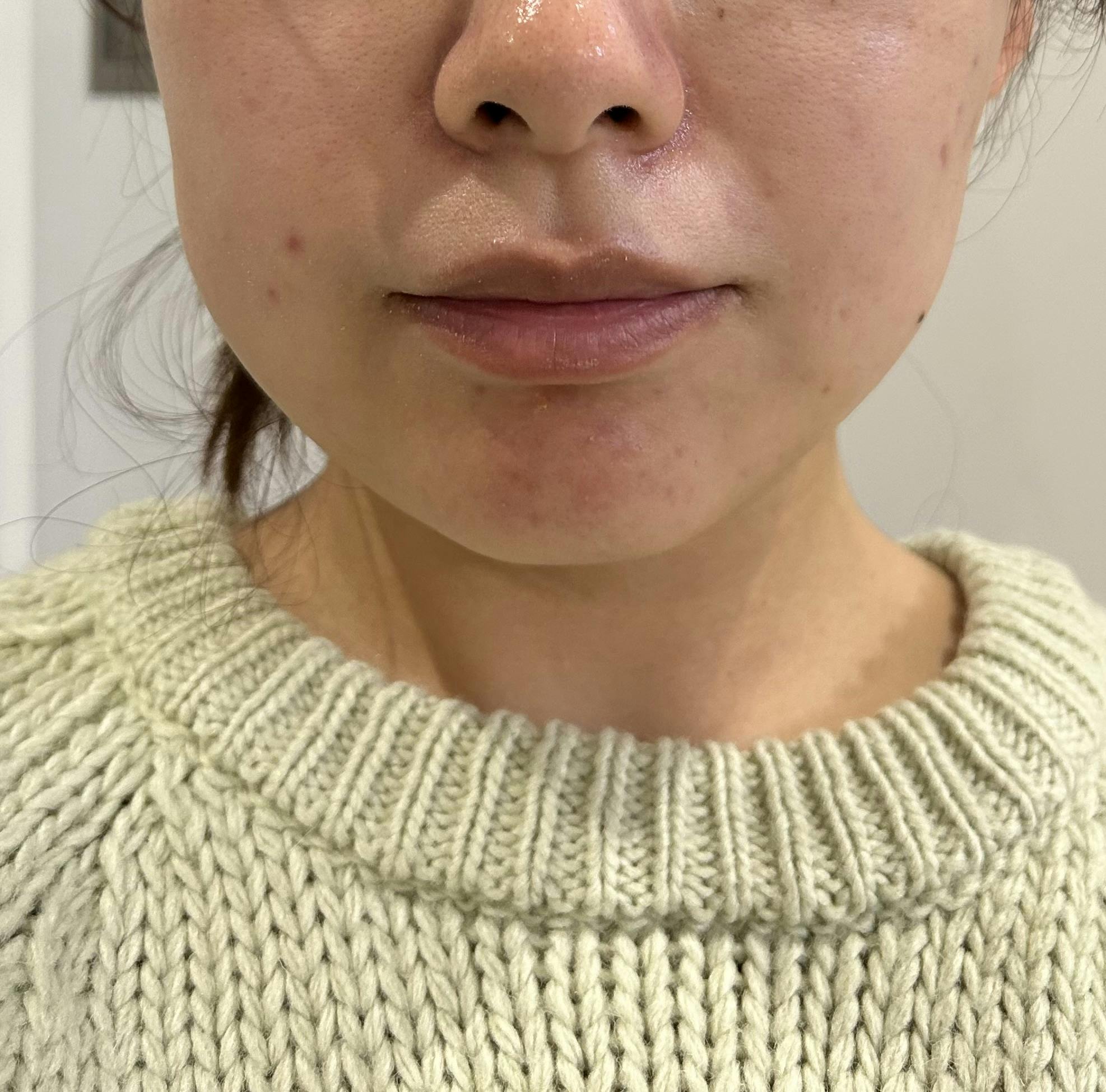 湘南美容クリニック 福井院でボトックス注射・エラボトックス注射(小顔)・韓国製ボトックス・ボツリヌストキシン・アラガン製ボトックスを受けたおもちさんの写真