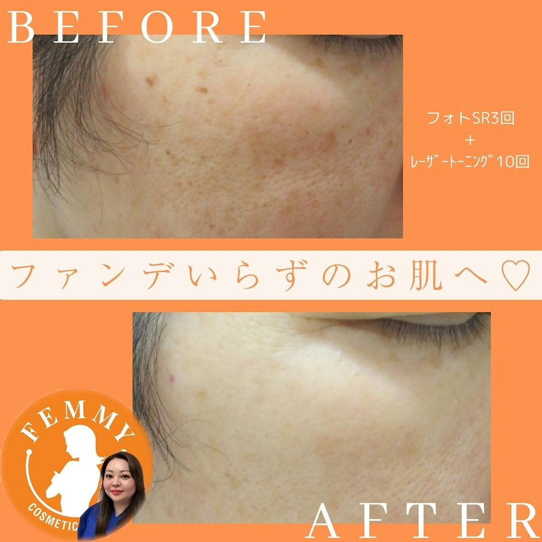 フェミークリニック 池袋院_before_aftar