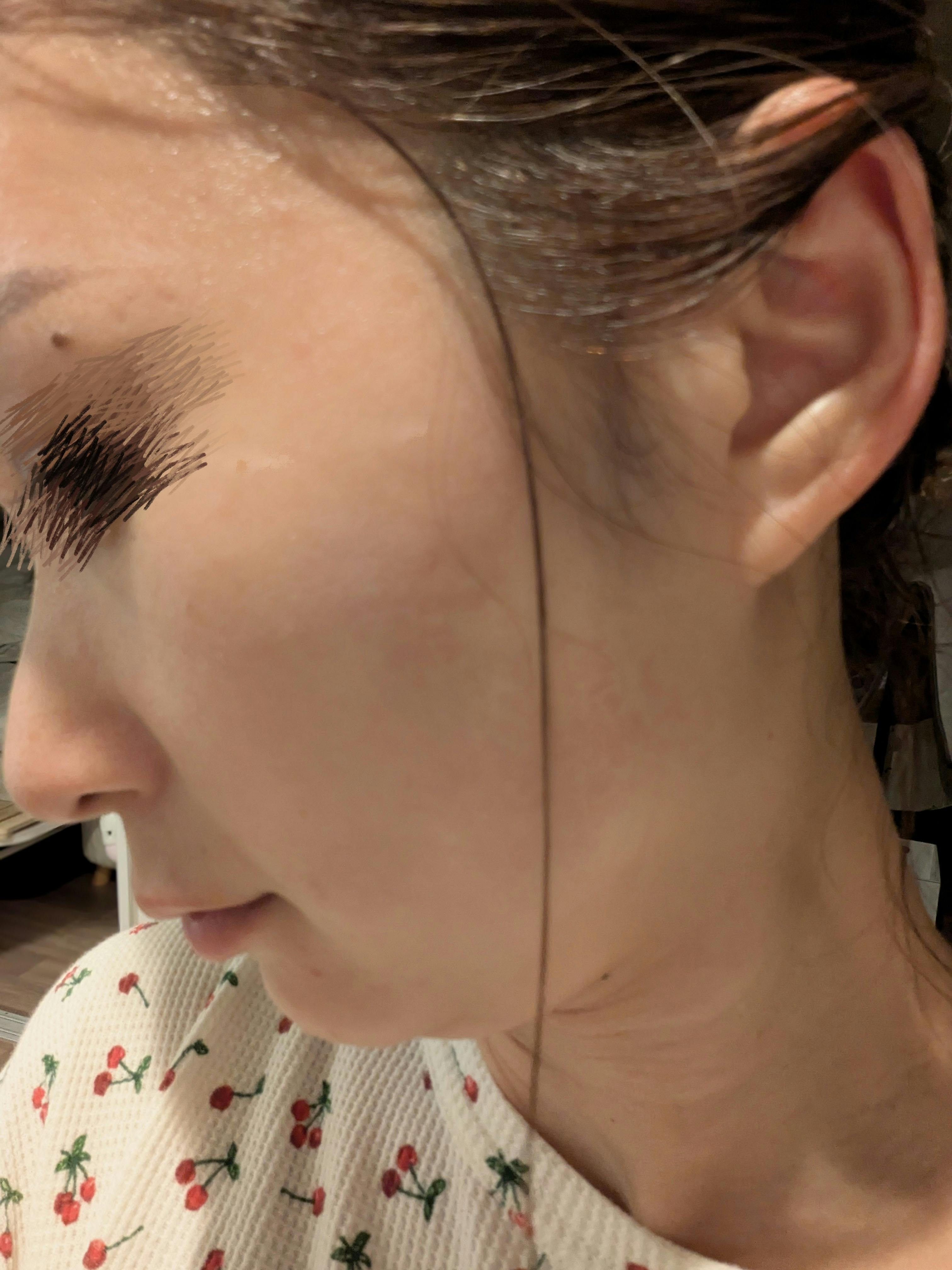 あやクリニックでIPL光治療(フォトフェイシャル)を受けたハッピーさんの写真