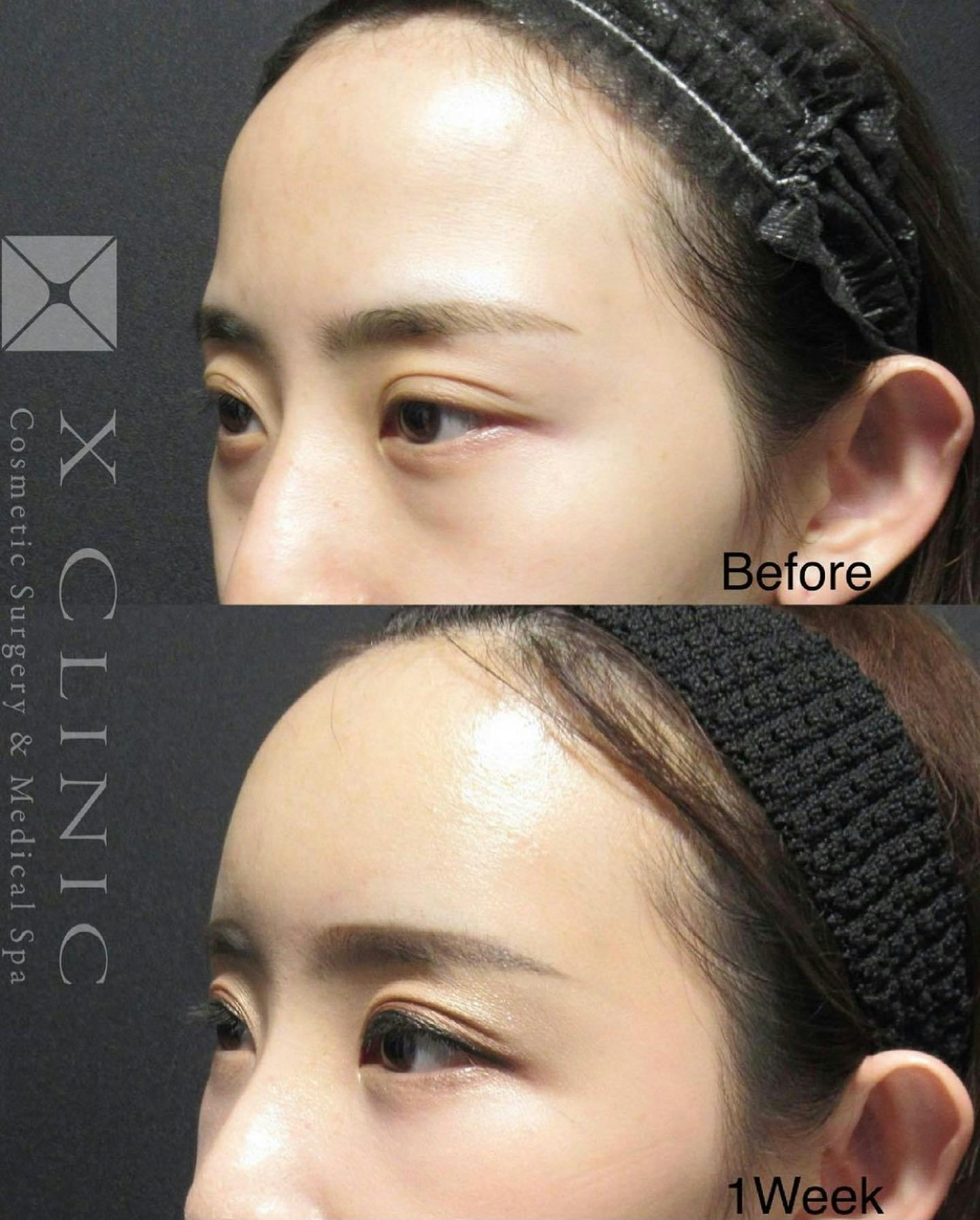 【女性・目元】クマ取りフルコース 額こめかみ脂肪注入 PRPオプション_before_aftar