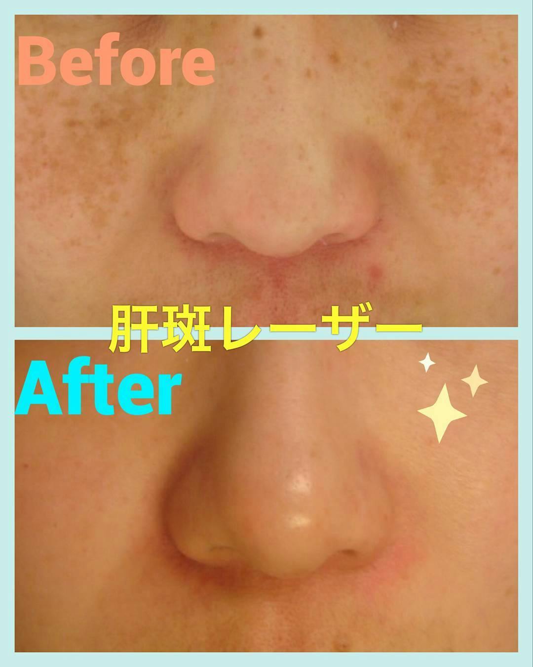 【50代女性・シミ】肝斑レーザー_before_aftar