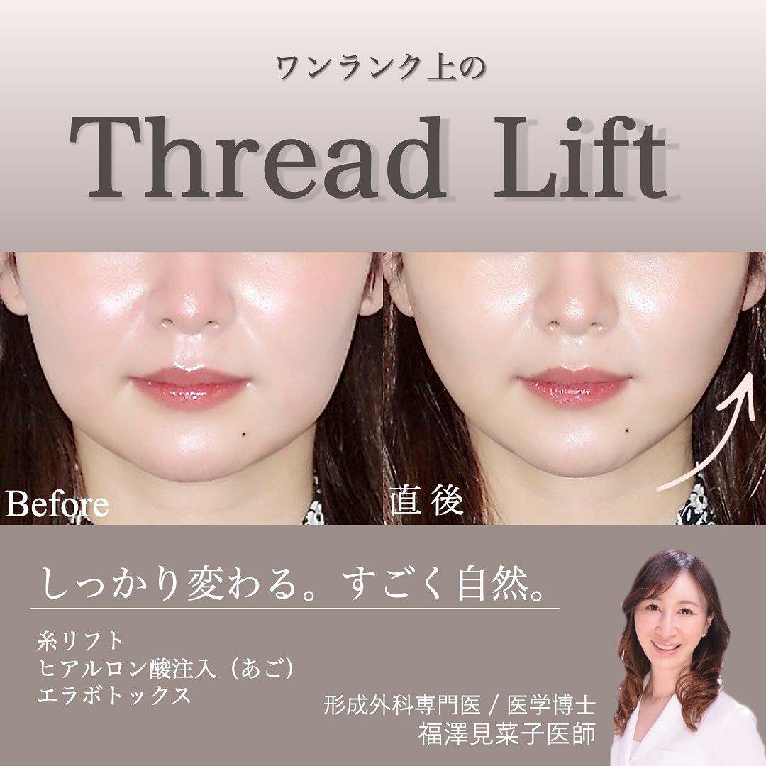 【女性・輪郭】クイックリフト、エラボトックス、ヒアルロン酸（顎）_before_aftar