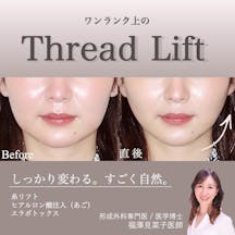 【女性・輪郭】クイックリフト、エラボトックス、ヒアルロン酸(顎)_before_aftar