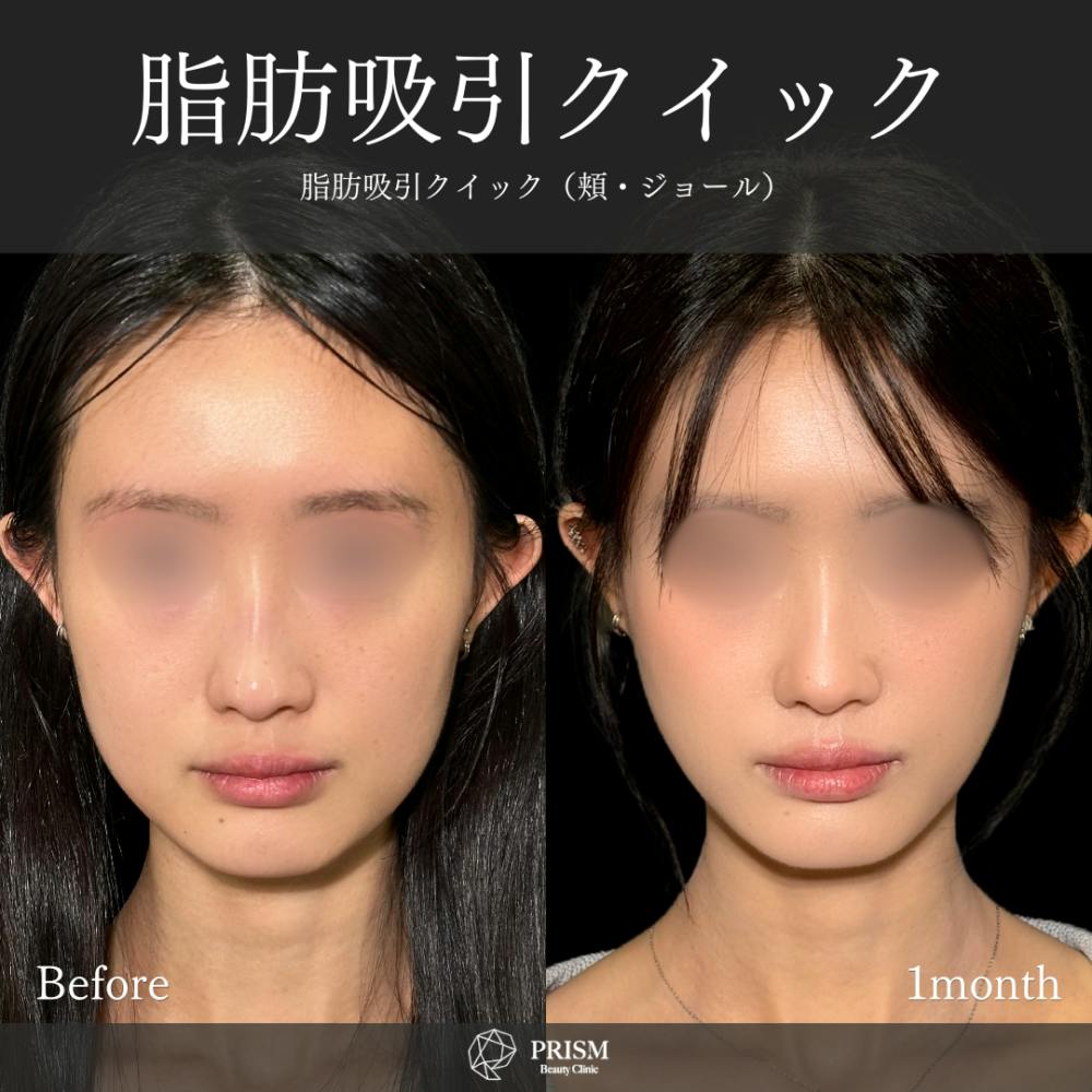 【20代女性・頬】脂肪吸引クイック（頬）_before_aftar