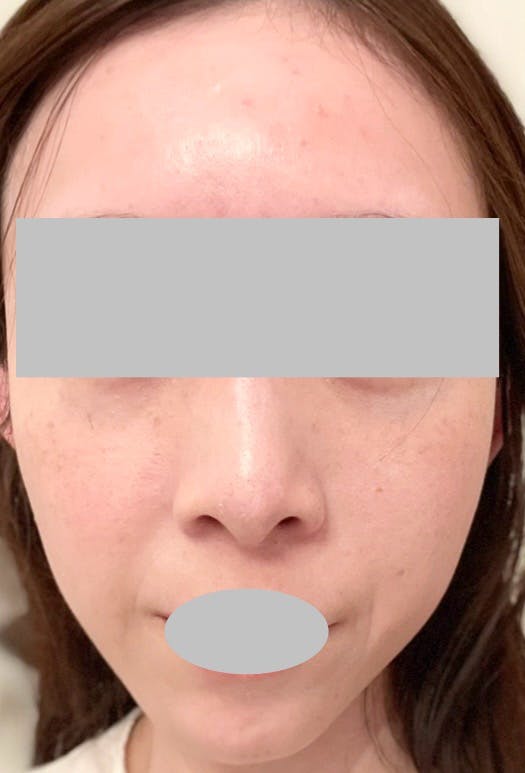 ピュアビューティー恵比寿(PURE BEAUTY)でマッサージピール(コラーゲンピール)を受けたarai03さんの写真