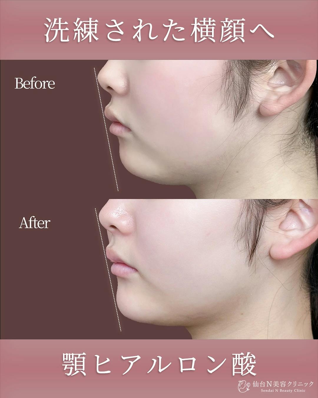 【女性・顎】ヒアルロン酸 ボラックス_before_aftar