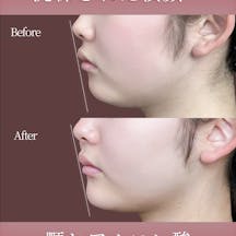 【女性・顎】ヒアルロン酸 ボラックス_before_aftar