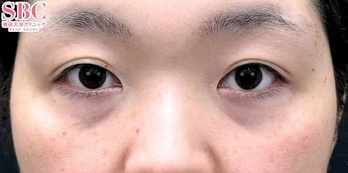 【40代女性・クマ】裏ハムラ法、ナチュラル脂肪注射ナノリッチ_before