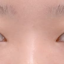 【女性・目元】線留めクロス二重術 自然癒着セット(上眼瞼脱脂)_before