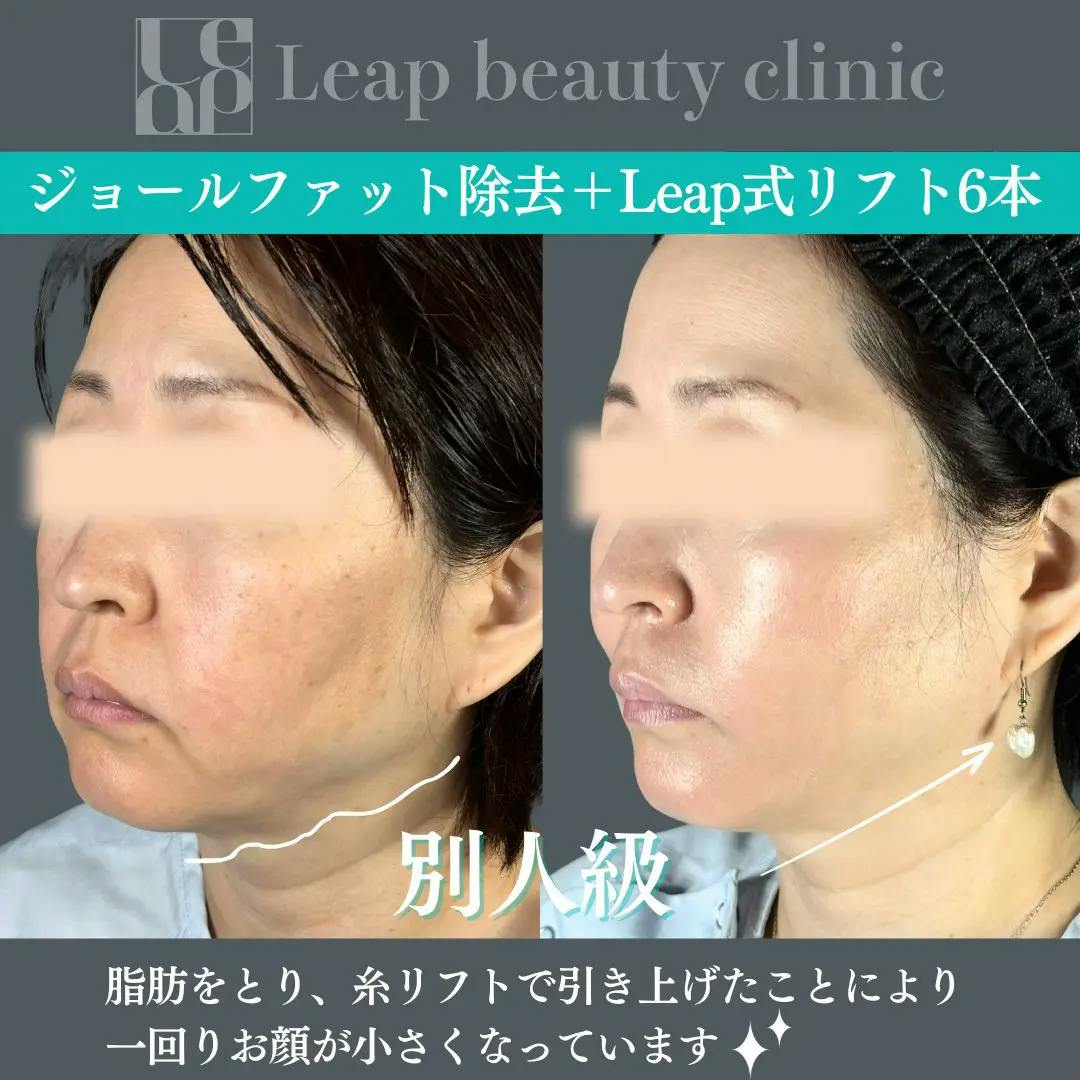 【40代女性・輪郭】ジョールファット除去・糸リフト_before_aftar