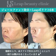 【40代女性・輪郭】ジョールファット除去・糸リフト_before_aftar