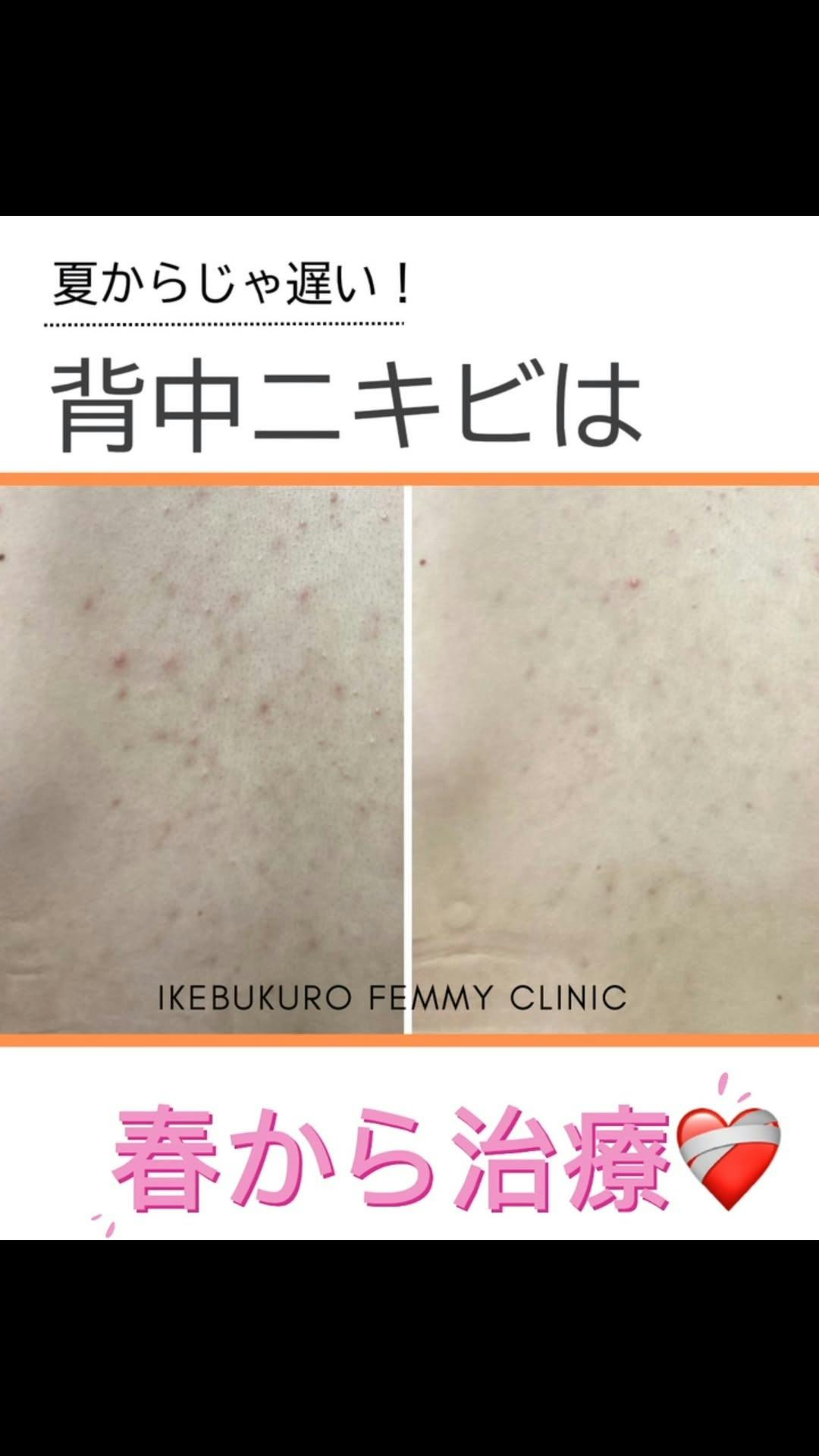 フェミークリニック 池袋院_before_aftar