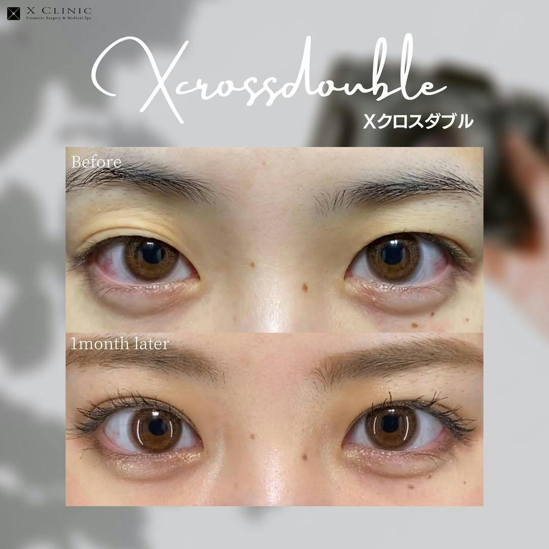 【女性・目元】Xクロスダブル_before_aftar