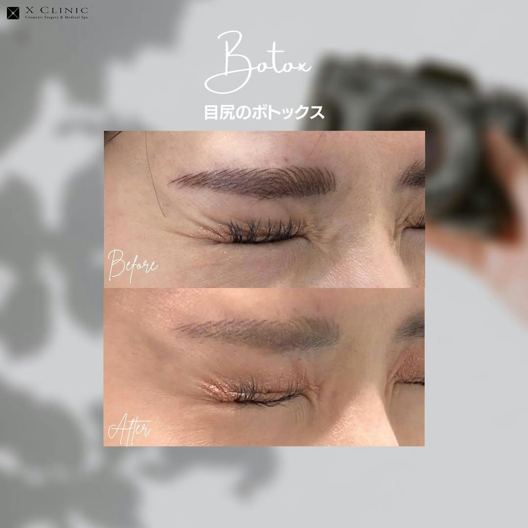 【女性・シワ】目尻ボトックス_before_aftar