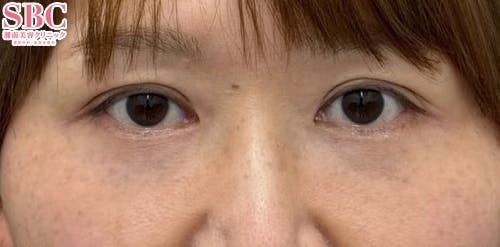 【女性・目の下】ナチュラル脂肪注射コンデンスリッチ、ナチュラル脂肪注射ナノリッチ、目の下の切らないクマ・たるみ（ふくらみ）取り_aftar