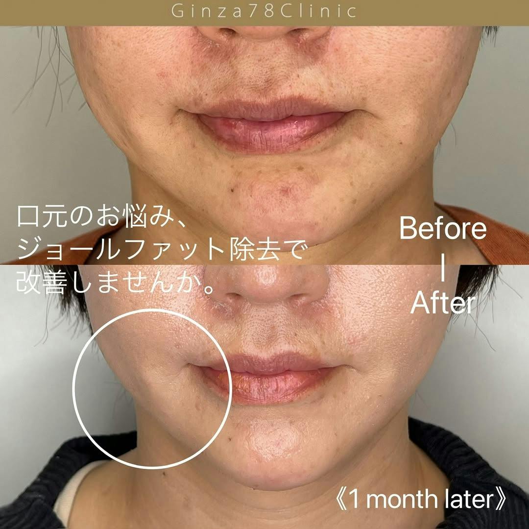 【女性・口元】ジョールファット除去_before_aftar