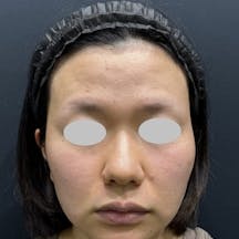 【30代女性・鼻】SBCプレミアムソフトプロテーゼ 鼻尖形成/鼻尖形成3D法(だんご鼻解消術) 鼻尖部軟骨移植_before