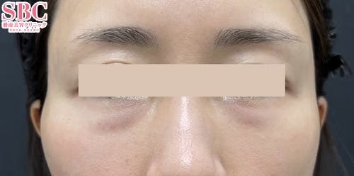 【女性・こめかみ】ヒアルロン酸ジュビダームビスタ バイクロスシリーズ_after