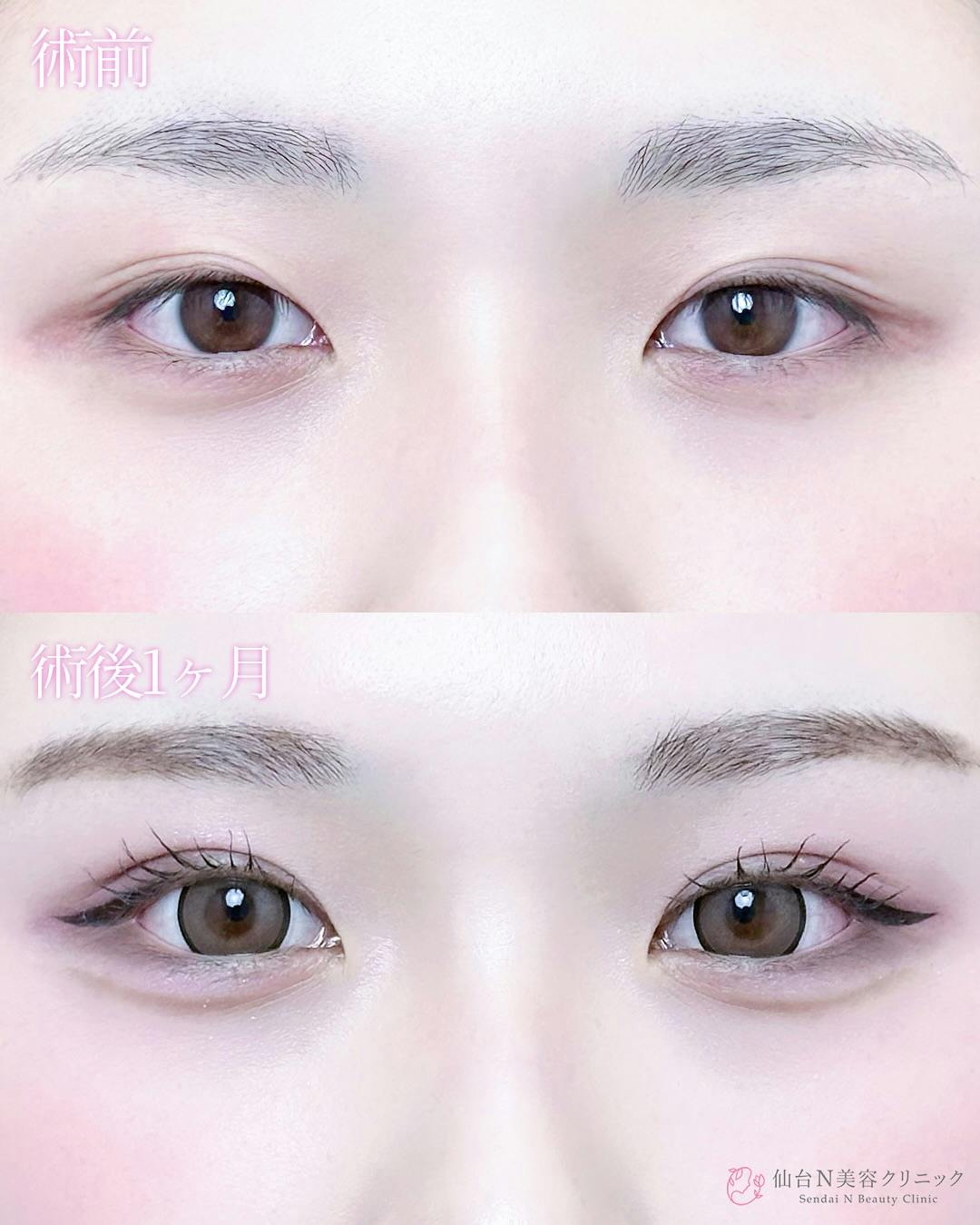 【女性・目元】二重埋没法（シークレットトリプル）_before_aftar