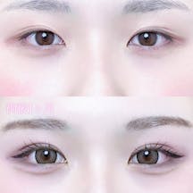 【女性・目元】二重埋没法(シークレットトリプル)_before_aftar