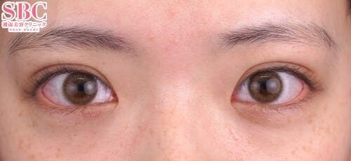 【10代女性・目元】クイックコスメティーク・トリプルNeo_1week