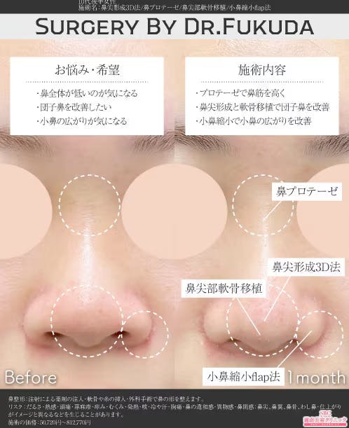 【10代女性・鼻】鼻尖形成3D法、鼻尖部軟骨移植、鼻プロテーゼ、小鼻縮小flap法_before_aftar