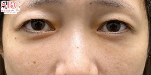 【30代女性・クマ】裏ハムラ法 SBCプレミアムPRP皮膚再生療法_after