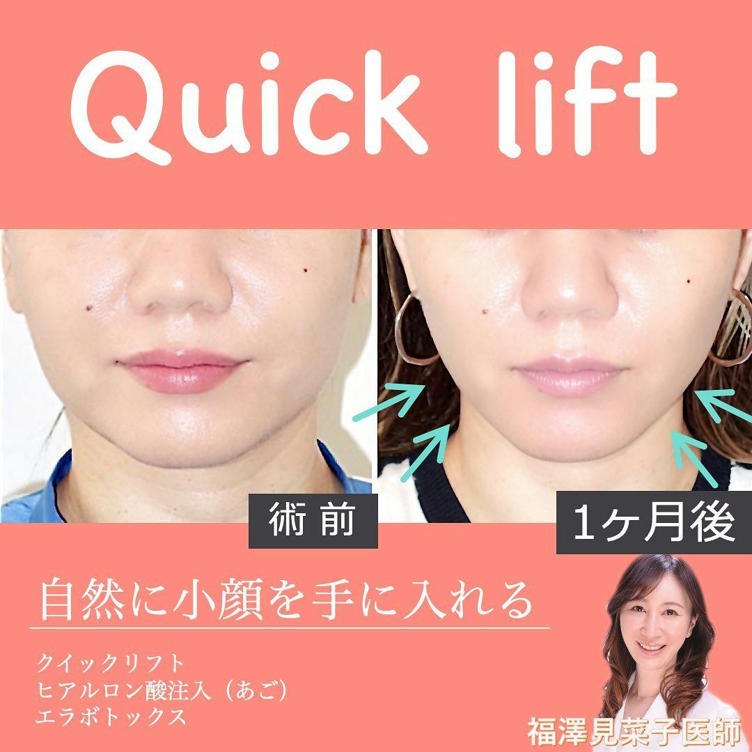 【女性・小顔】クイックリフト、エラボトックス_before_aftar