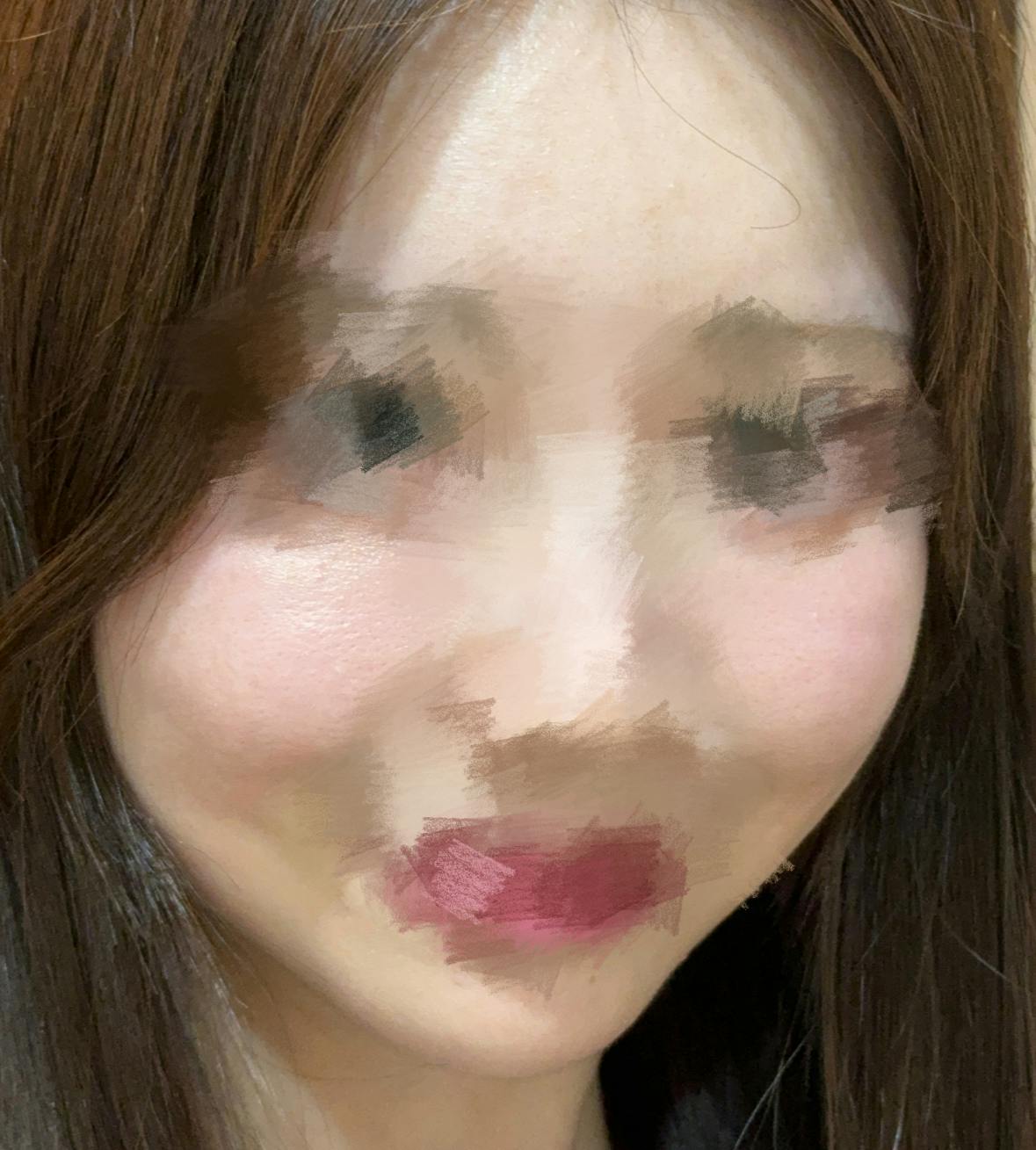 藤ナチュレ美容クリニック 銀座院でピコトーニング＋マッサージピール＋エレクトロポーション＋VISIA肌診断を受けたすてらさんの写真