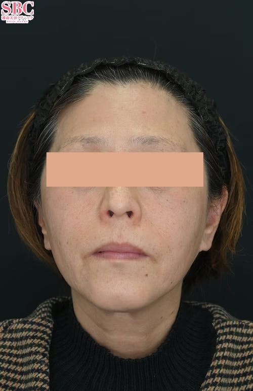 【女性・たるみ】プロファイロ_after