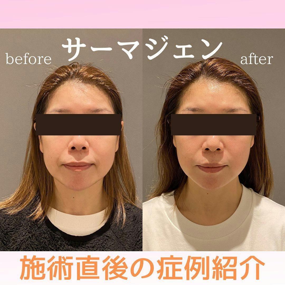 【女性・ほうれい線】サーマジェン_before_aftar