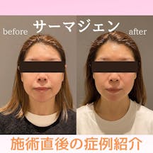 【女性・ほうれい線】サーマジェン_before_aftar