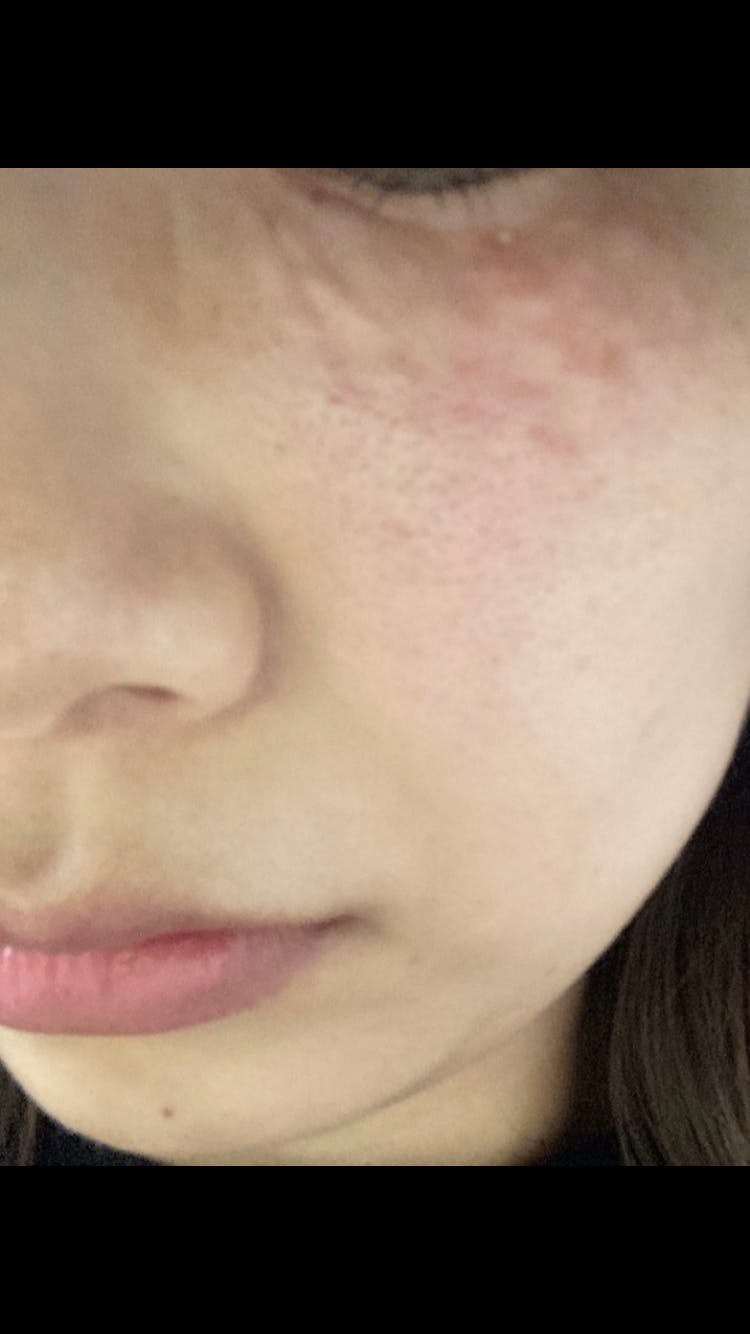 湘南美容皮フ科 福岡天神院で女優注射を受けたぴょんさんの写真