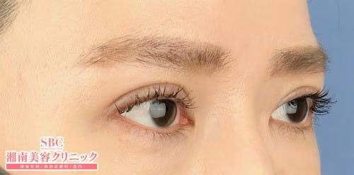 【女性・目元】タルミ取り併用全切開法二重、眼瞼下垂_after
