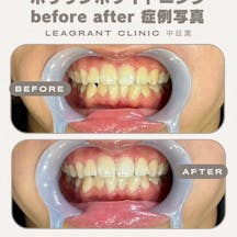 【20代男性・歯】ポリリンホワイトニング_before_aftar