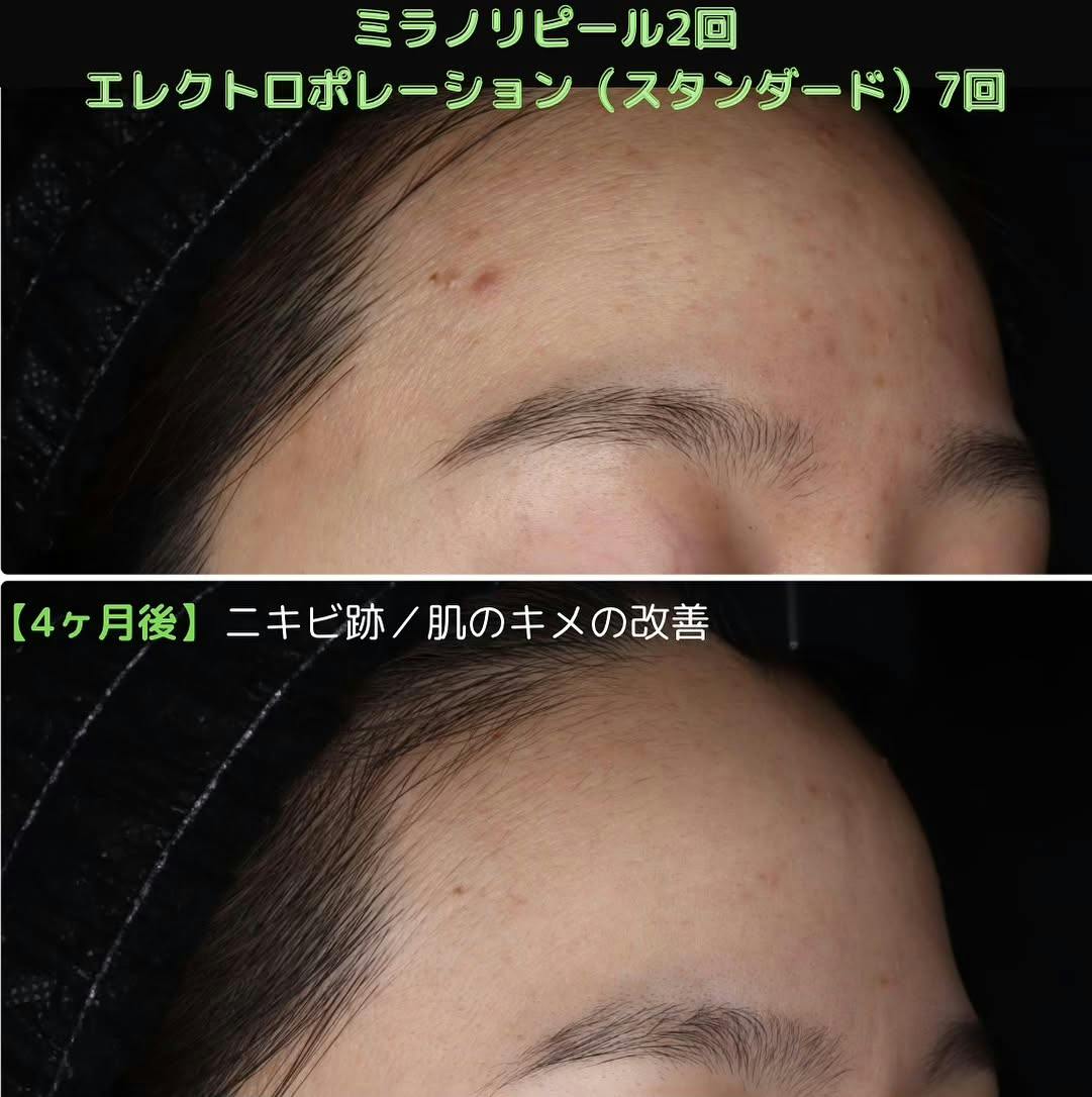 エレクトロポレーションができる美容クリニックの症例写真・ビフォー