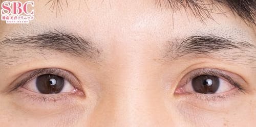 【40代男性・目元】眼瞼下垂＋二重_1month