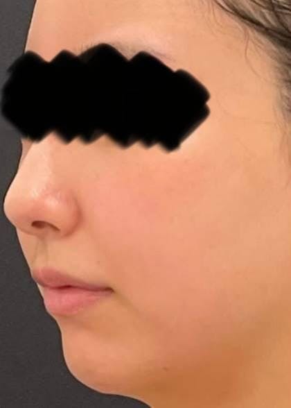 みずほクリニックで脂肪吸引（顎下）：ベイザー脂肪吸引を受けたゆるふわドカ食いちゃんさんの写真