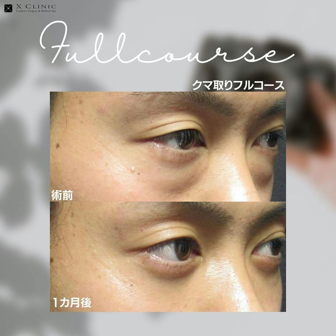 【男性・目元】クマ取りフルコース_before_aftar