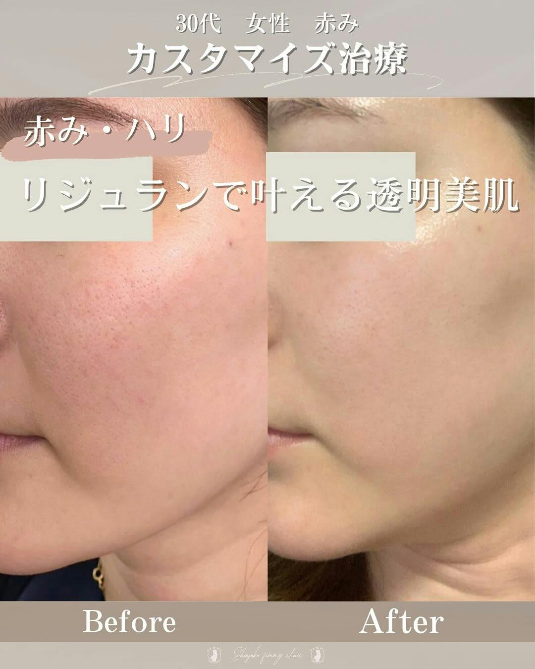 【30代女性・赤み】リジュラン_before_aftar