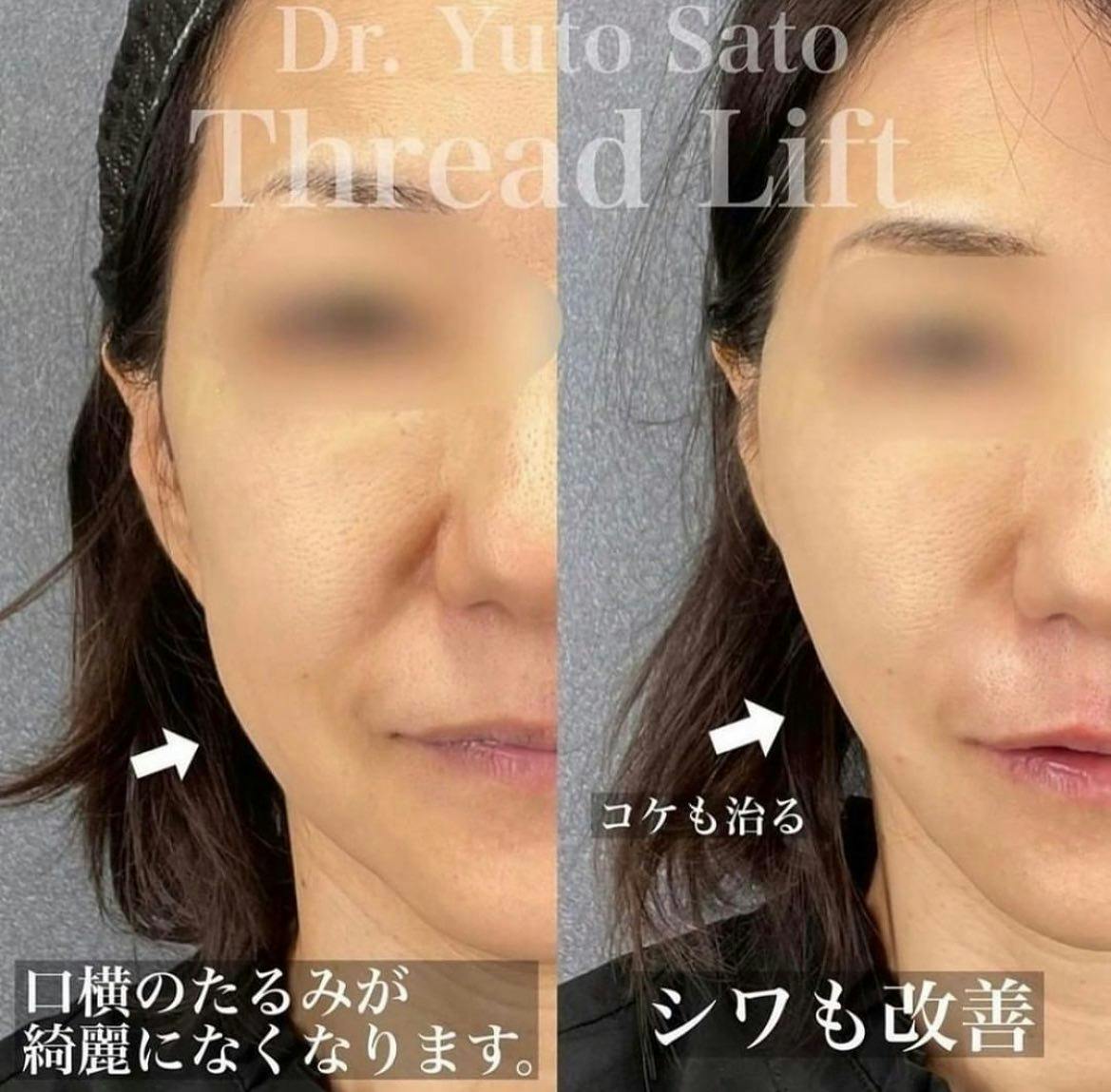 【女性・たるみ】糸リフト_before_aftar