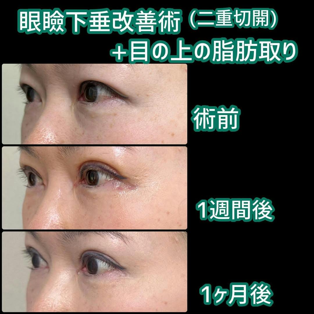 【女性・目元】眼瞼下垂術+二重切開法_before_aftar