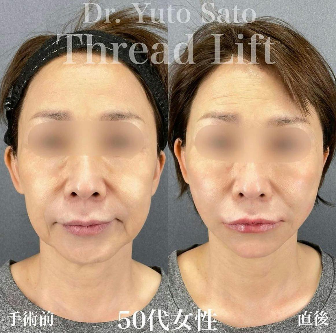 【50代女性・輪郭】糸リフト ヒアルロン酸_before_aftar